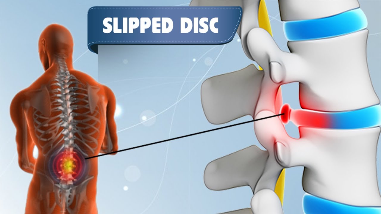 Slip Disc