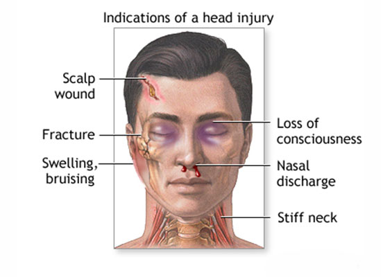 Head Injury